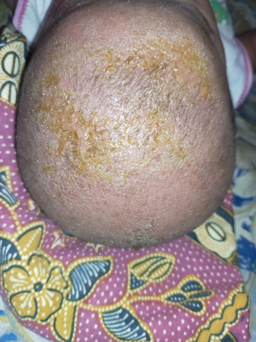 kerak di kepala