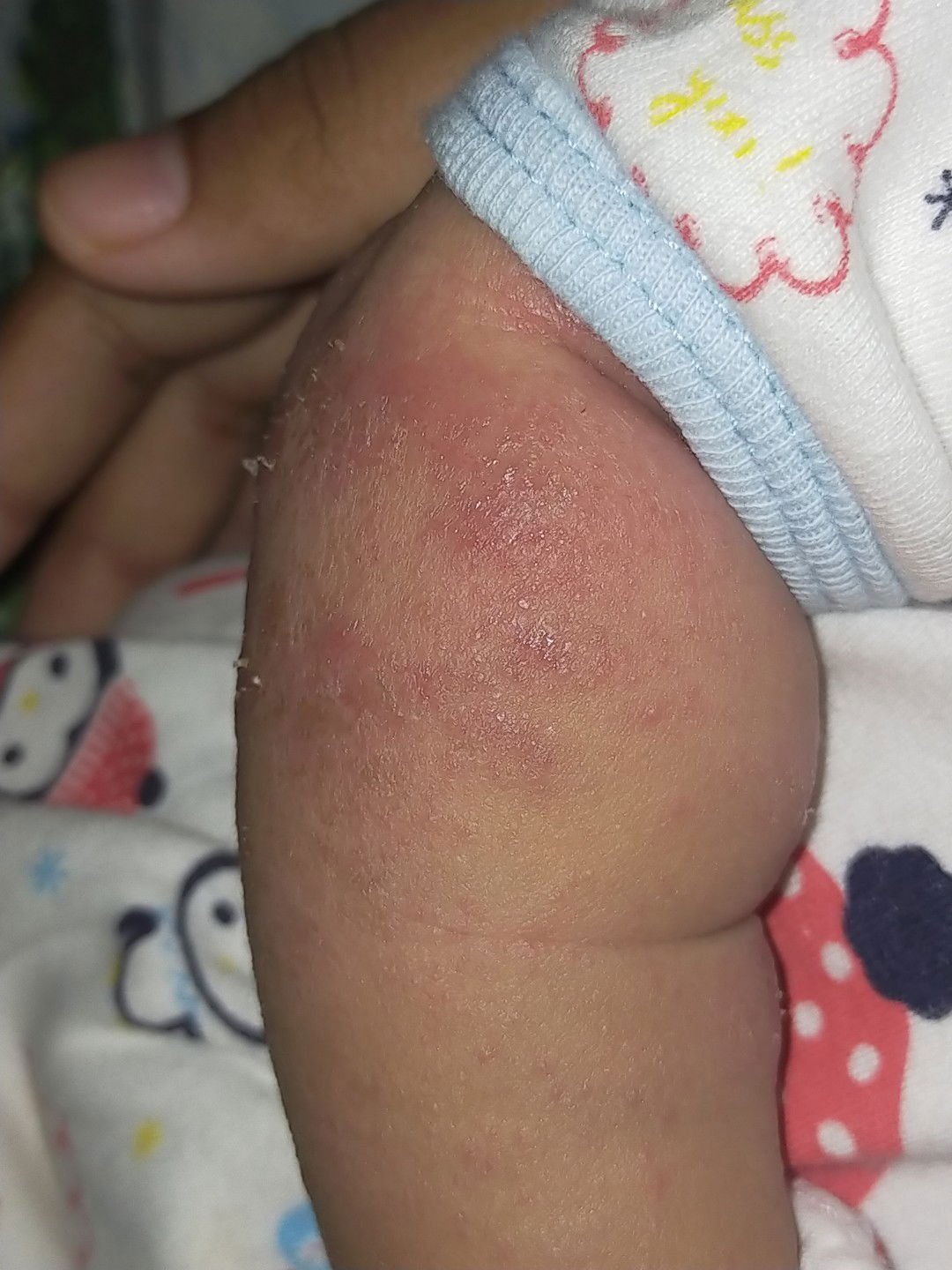 alergi/biang keringat