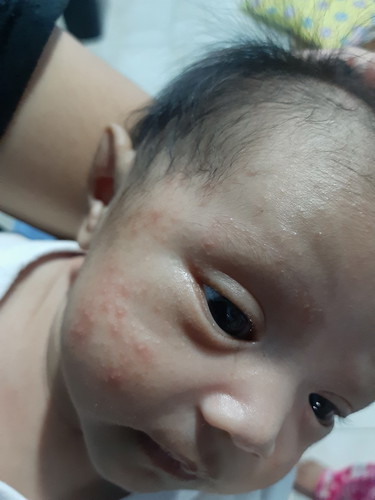 baby acne