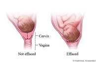 manipis na cervix