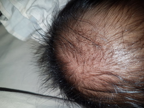 dark spots