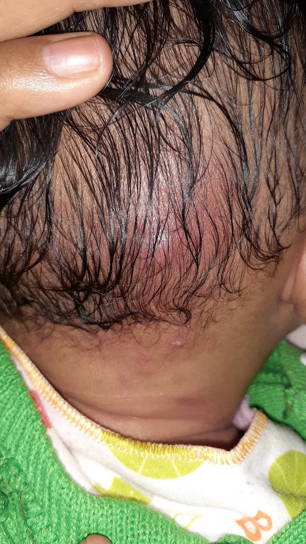 belakang kepala bendol