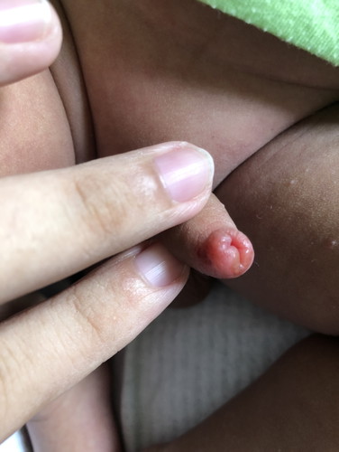Rashes?
