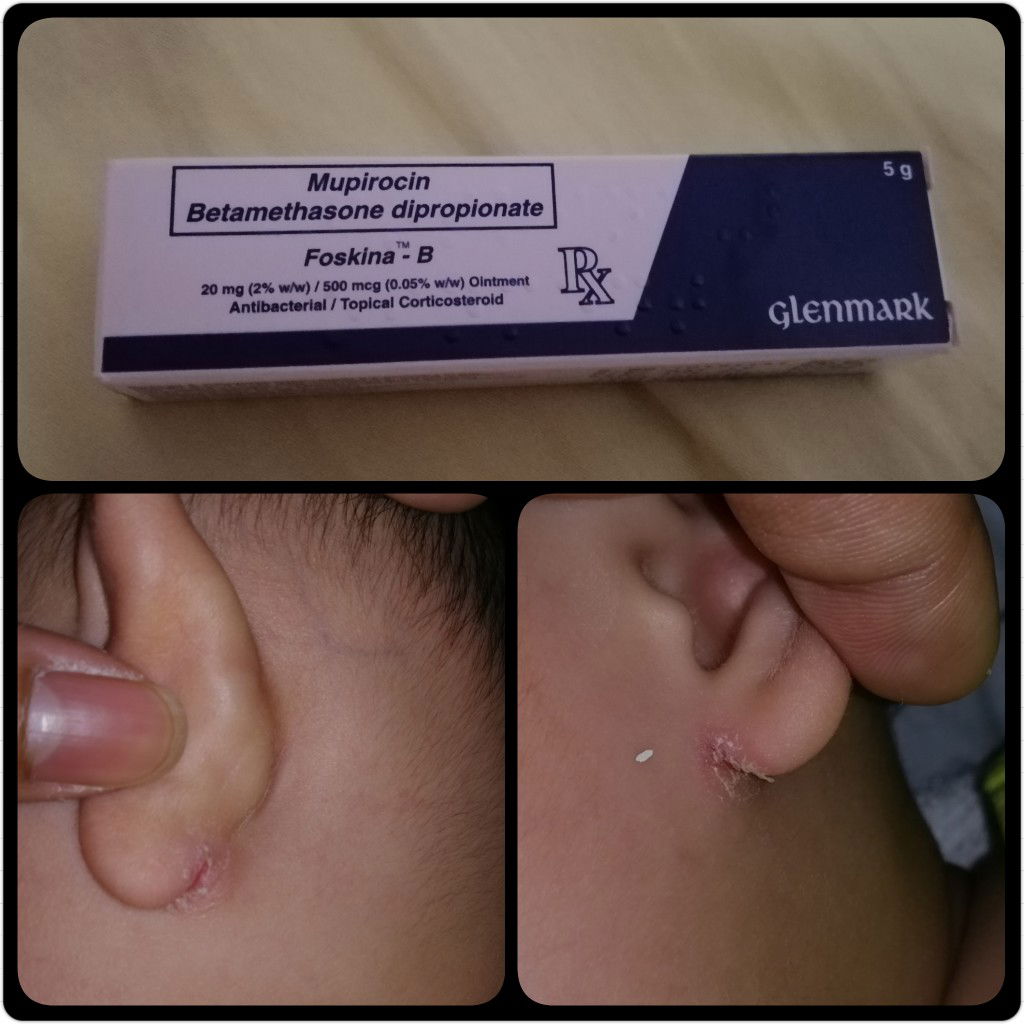 Split Skin Under Earlobes