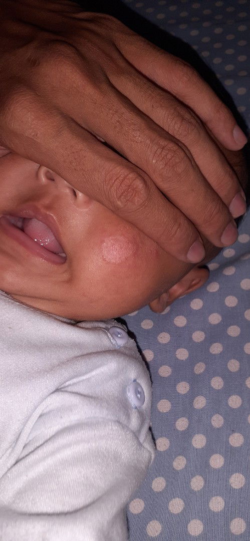 kulit merah agak putih (spt panu) pada bayi