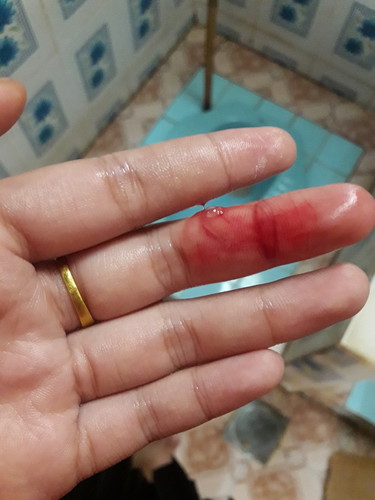 เราเป็นอะไรค่ะ ส่งผลอะไรต่อลูกไหมค่ะ