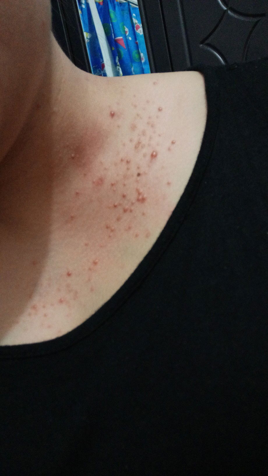 Ruam gatal dan merah selama kehamilan