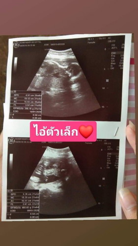 รบกวนช่วยดูภาพอัลตร้าซาวด์ให้หน่อยค่ะ ว่าลูกในท้องเป็นเพศอะไร