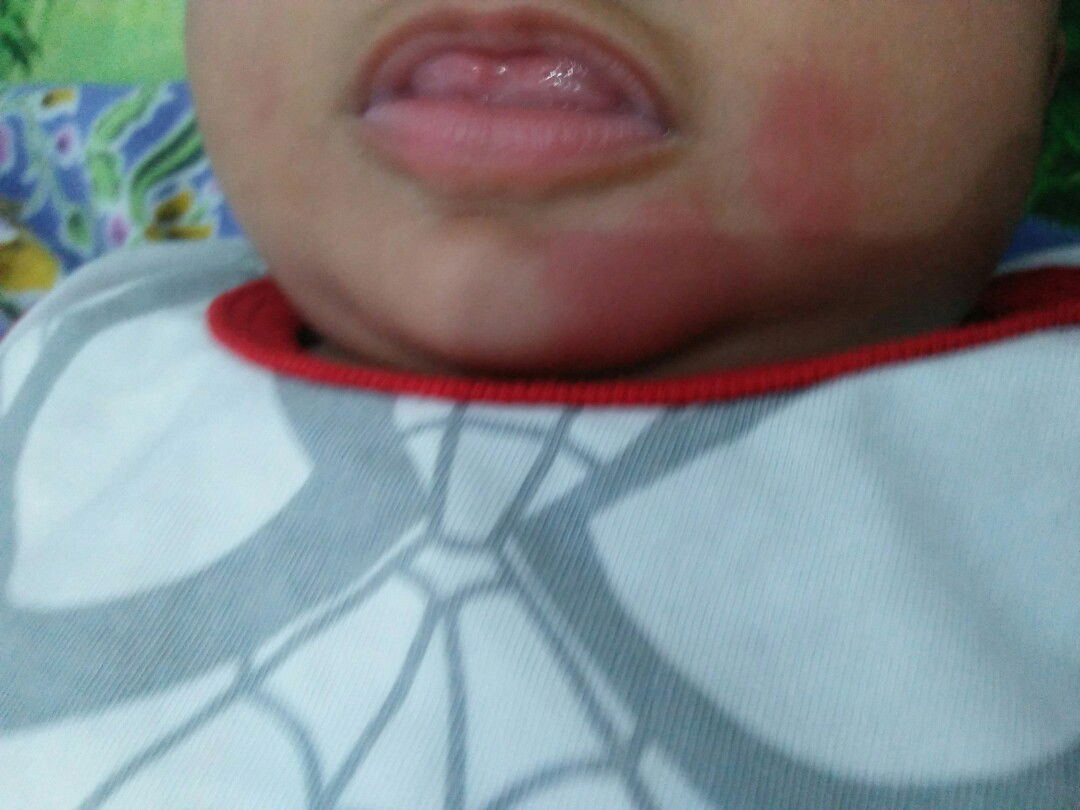 bentol di pipi dan dagu