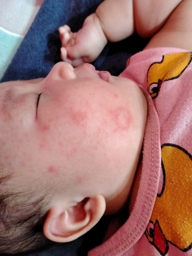 ผื่นขึ้นหน้า หูเป็นแผล