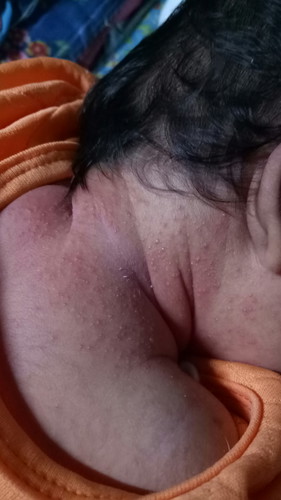 มีเม็ดขึ้น