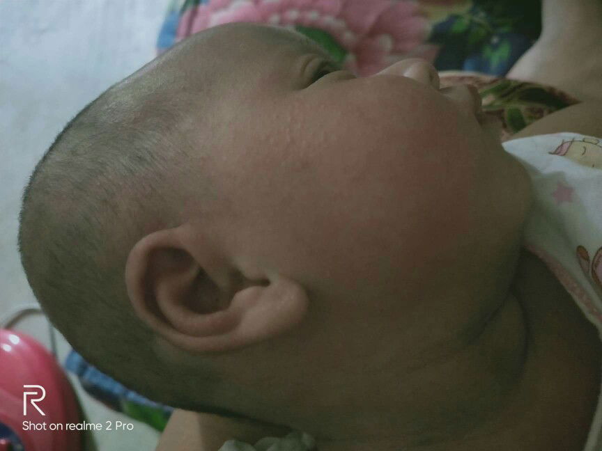 น้องเป็นเม็ดเป้นผื่นแดง