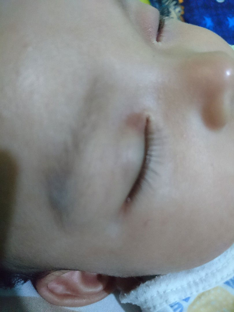 kelopak mata bayi merah