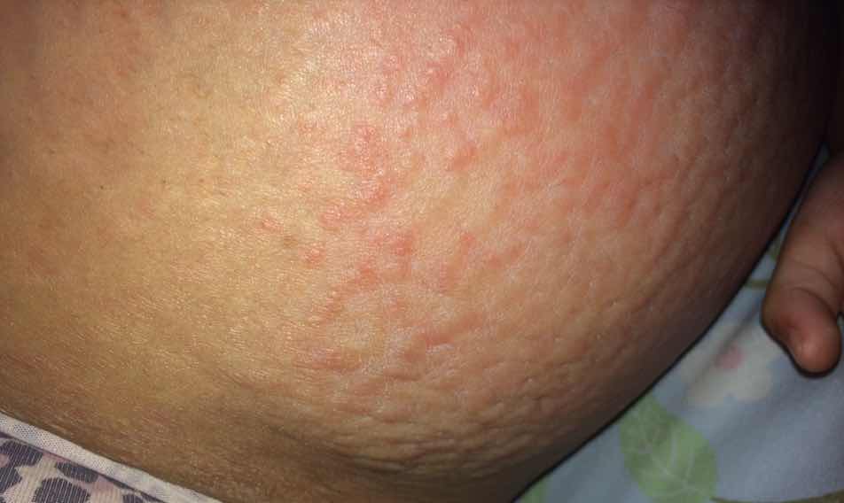 Itchy Belly at 37weeks