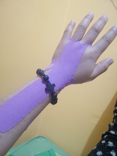 Carpal Tunnel Syndrome