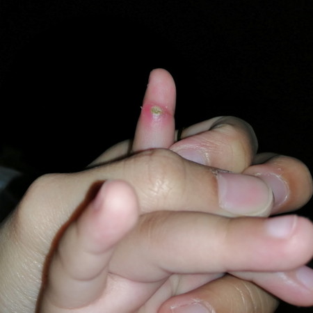 แผลหนอง