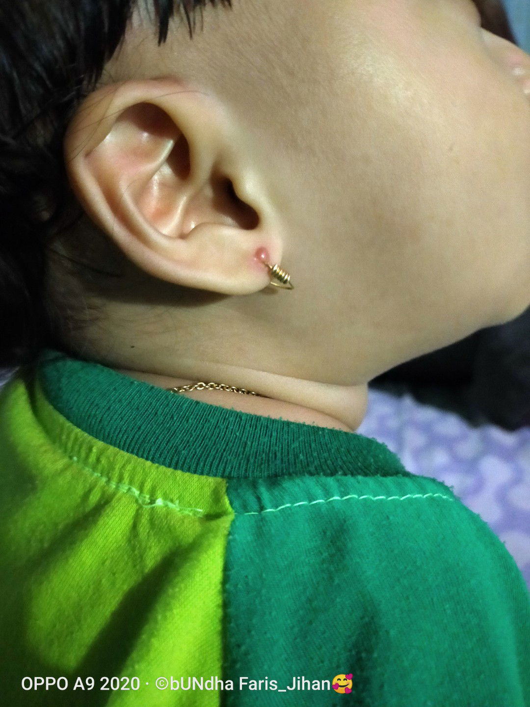 tindikan telinga anak bengkak kaya bisul