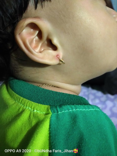 tindikan telinga anak bengkak kaya bisul