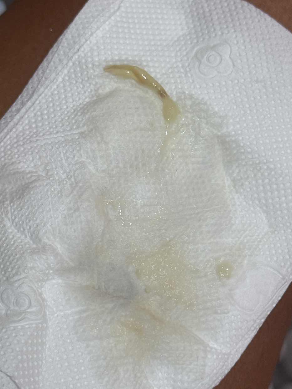 มีมูกออกตอนตั้งครรภ์ได้ 22 สัปดาห์