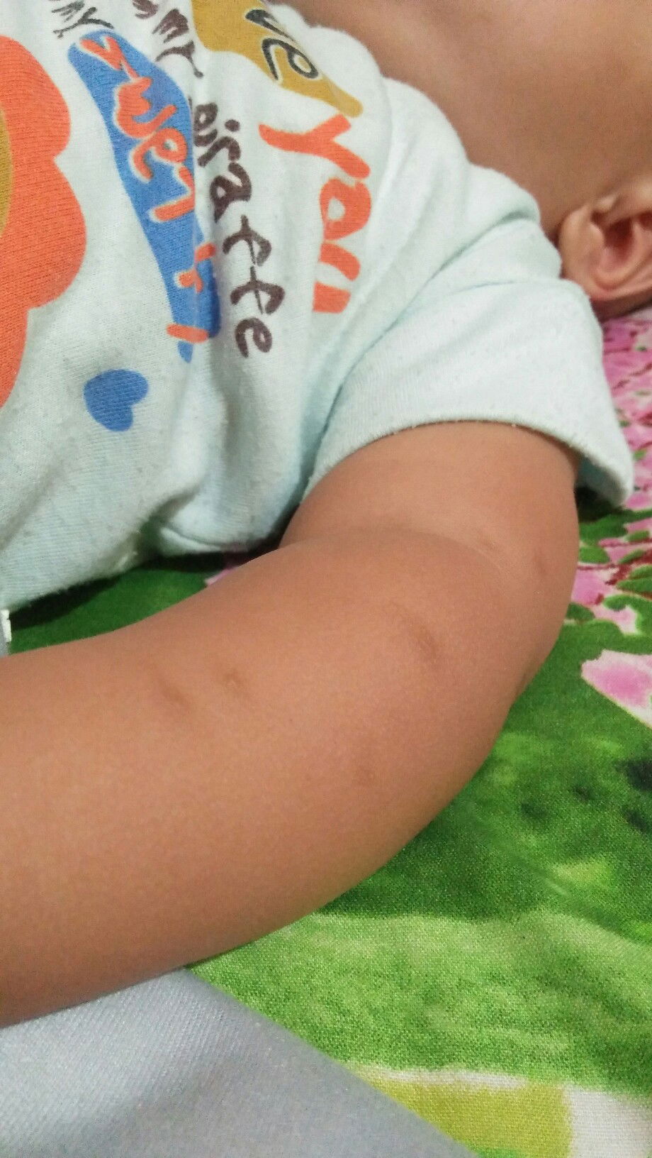 bekas gigitan nyamuk