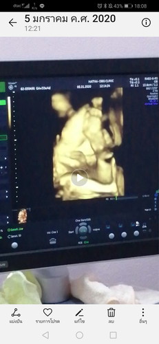 ท่านอนในท้อง