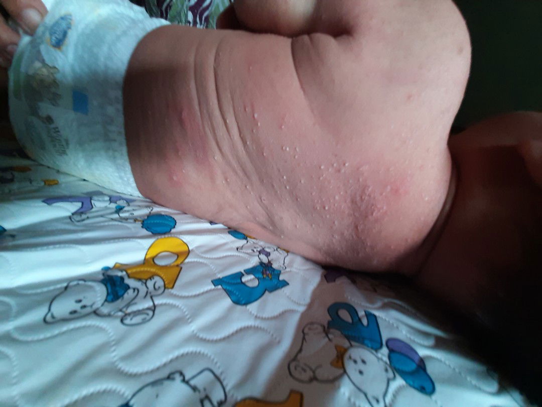 jerawat punggung bayi