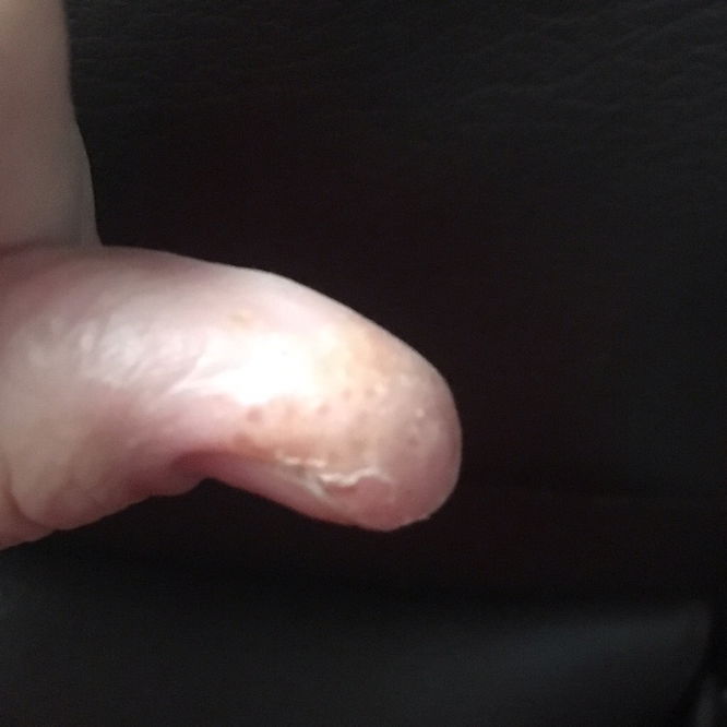 Kulit sensitif setelah melahirkan