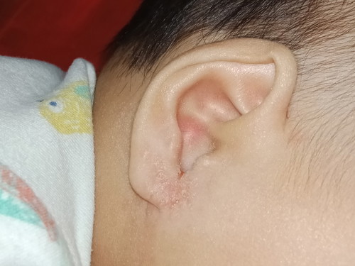 ผื่นอะไรตรงติ่งหู