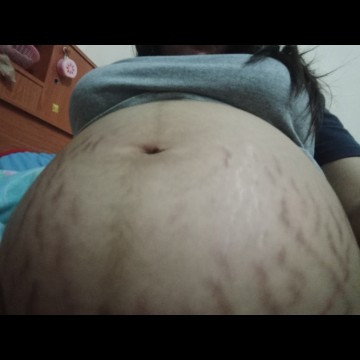 มีคุณแม่คนไหนท้องแตกลายแบบนี้บ้างค่ะ