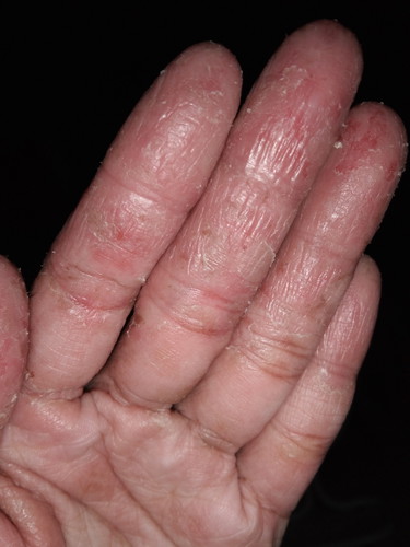 ECZEMA