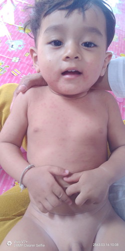 น้องเป็นผื่นเต็มตัวทำงัยดีค่ะ
