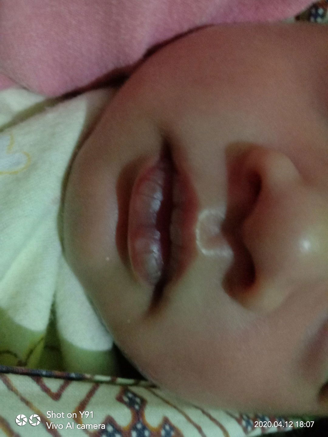 bibir baby pecah2