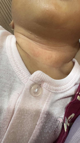 Bruntusab pada leher bayi