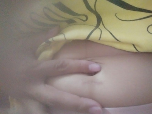 แผลหมัน