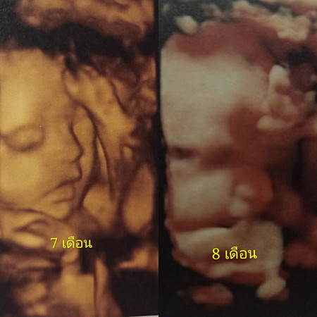 แก้มป่องขึ้น