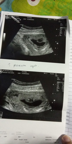 doktor jumpa dua placenta