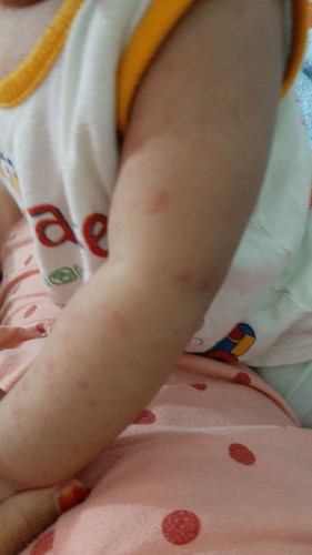 Alergi Bayi usia 7 bulan