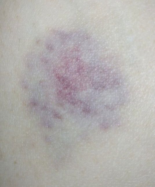 Tiba2 banyak biru di kaki