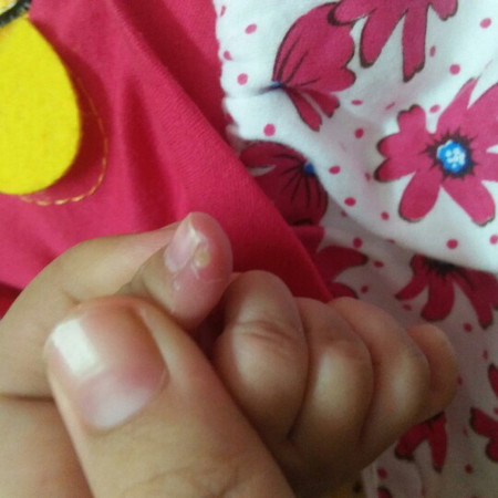 tangan baby bengkak
