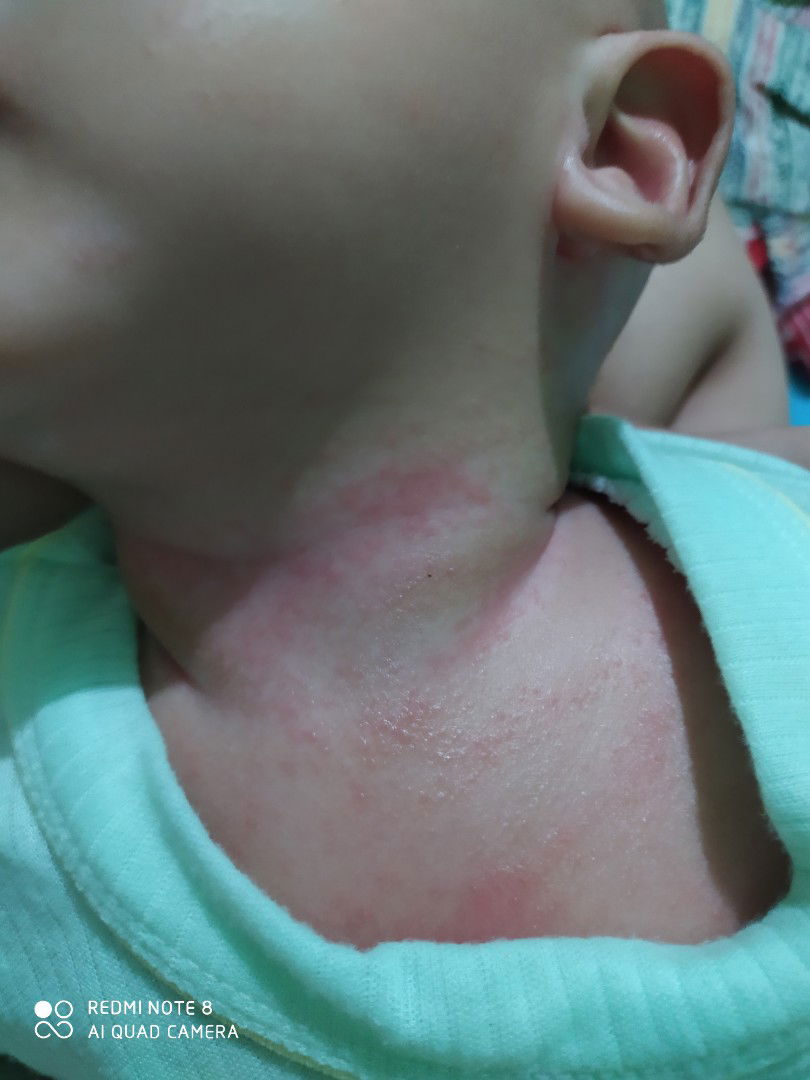 ruam atau apa ya bun