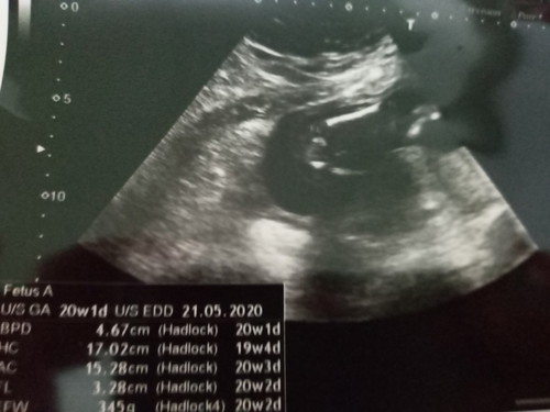 ตั้งครรภ์ จะ6เดือนแล้ว