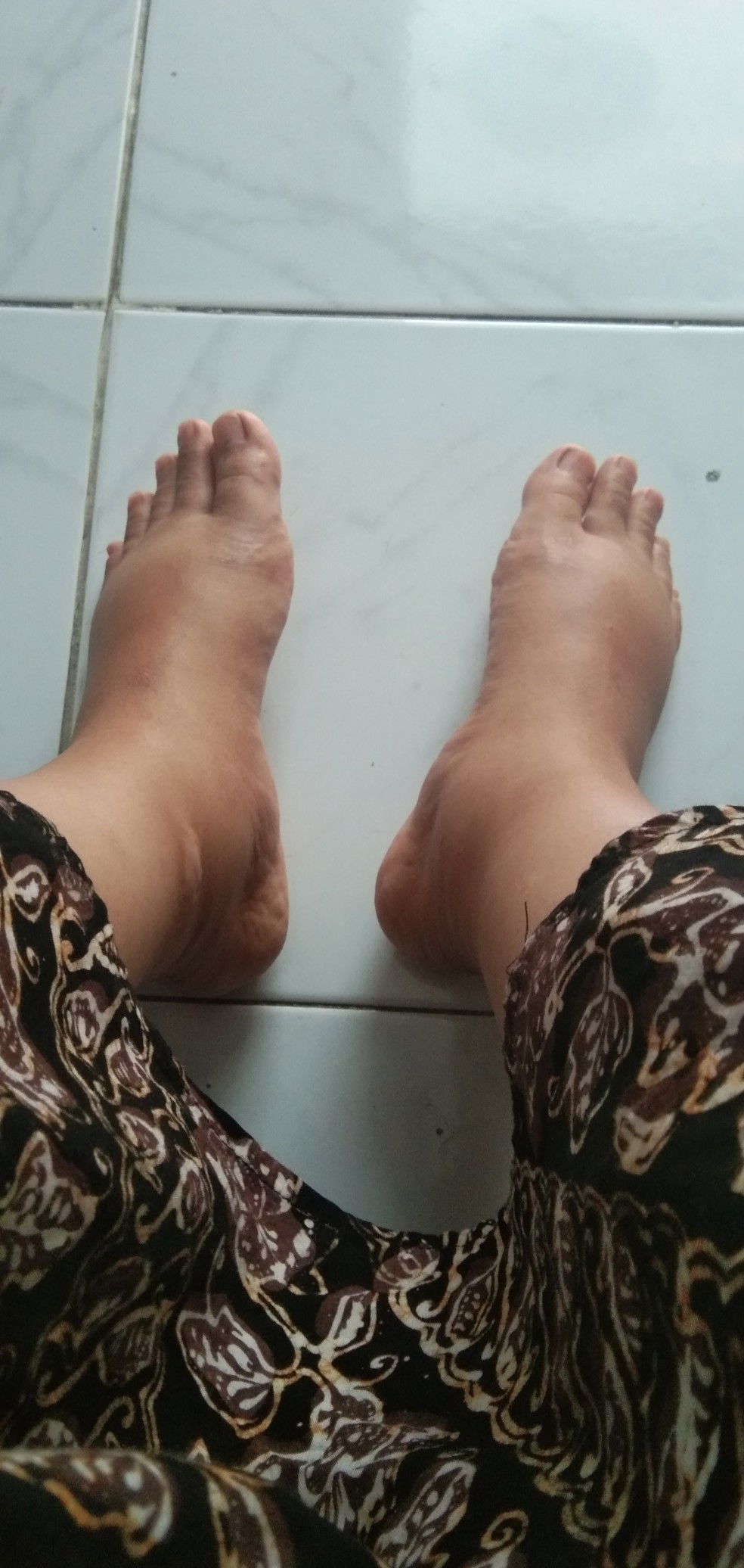 kaki bengkak setelah melahirkan