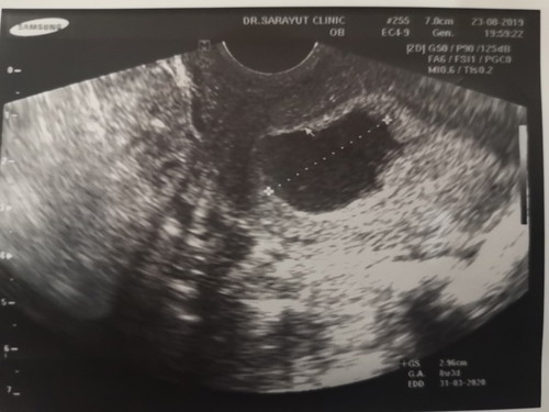 6 วีค ซาวด์ไม่เจอน้องมีแต่ถุงตั้งครรภ์ค่ะ