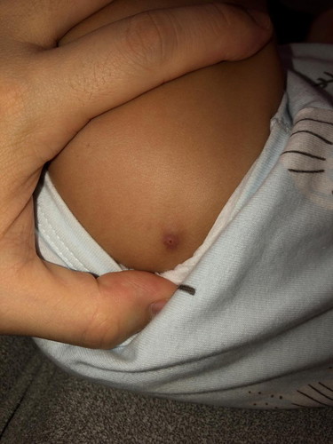 Wound At Baby's Butt Cheek