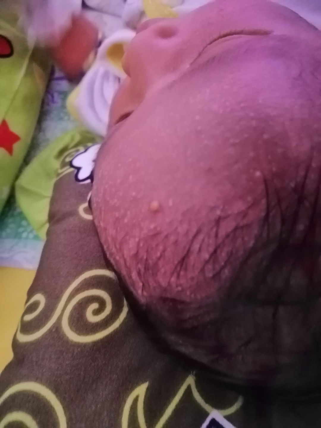 Bruntusan Dikepala Bayi