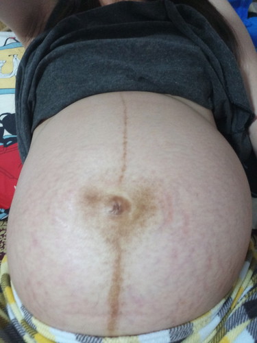 ท้องลาย หน้าเป็นสิว เป็นฝ้า