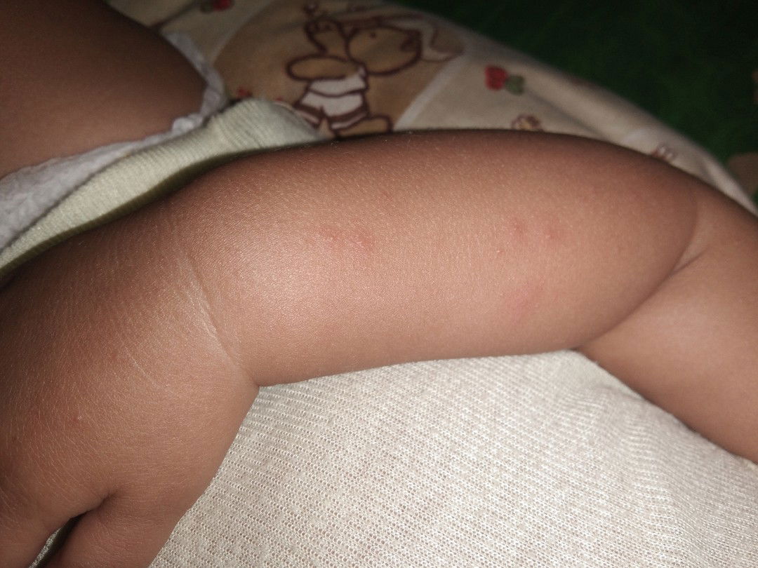 tangan ank bintik2 merah