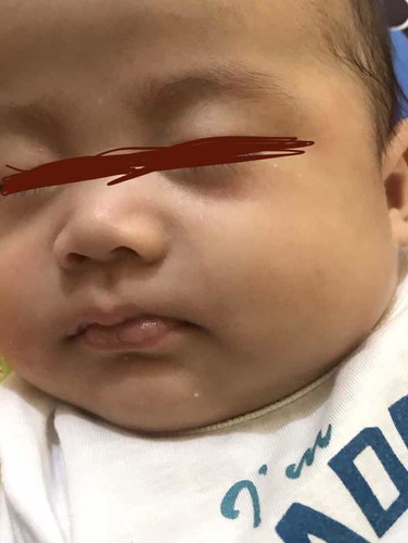 Red patches on my baby’s face.