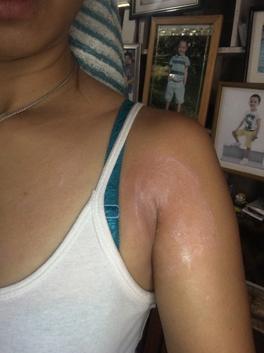 Anu Best Para sa ALLERGIES