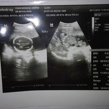 Hasil USG